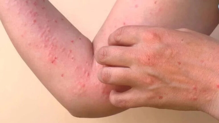 Un virus extrem de periculos a ajuns în România. Cum se transmite Chikungunya și care sunt simptomele